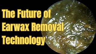 The Future Of Earwax Removal Technology