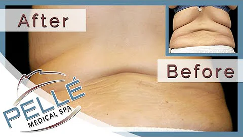 Laser Liposuction Bedford - Special Offer - Pelle Medical Spa