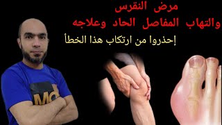 علاج النقرس النهائي Gout وإلتهاب المفاصل اليوريك أسيد خطأ شائع  د يوسف الملاحي