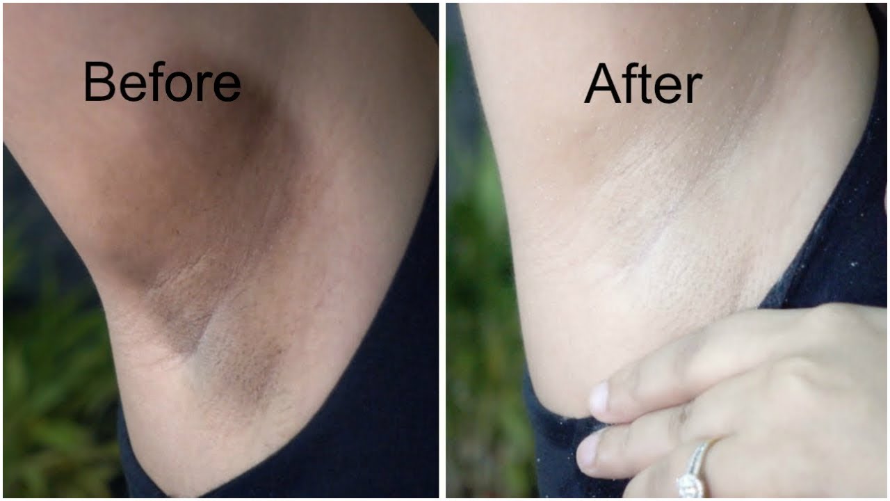 😱Instant Result - Underarms Whitening Home Remedy 100% WORKS | Simplestyletips - YouTube
