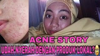 MY ACNE STORY, UDAH NYERAH DENGAN PRODUK LOKAL?