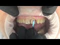 ASMR Dentist 🦷 Teeth Design and Teeth Cleaning l Dentist Cleans Your Teeth!!