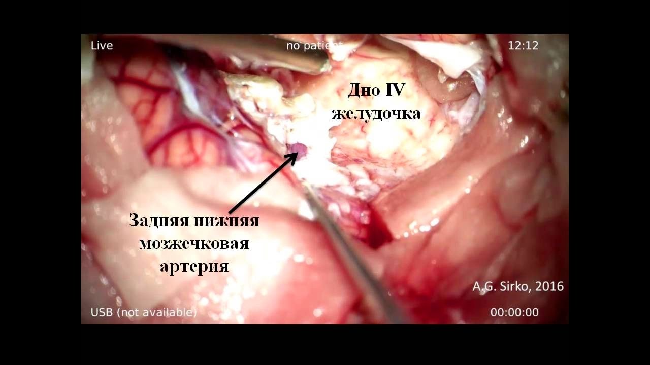 ⁣Гигантская эпидермоидная опухоль IV желудочка 1 часть