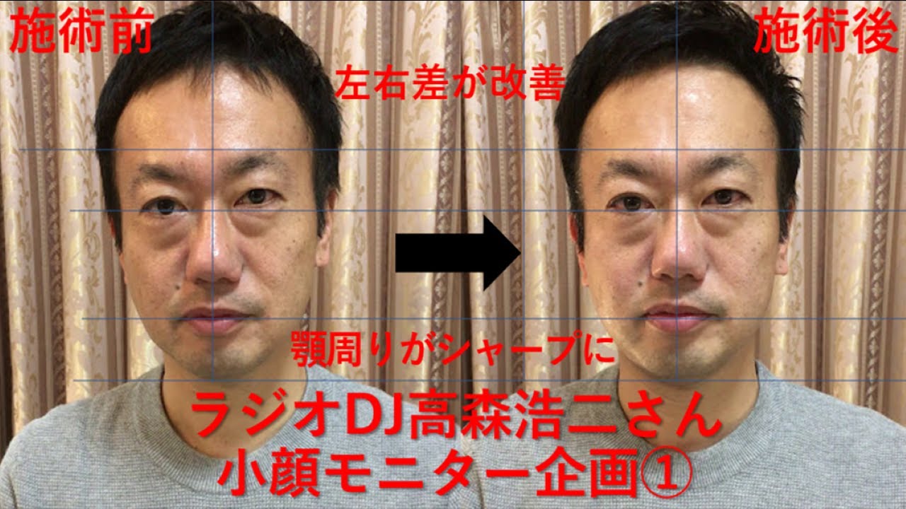 小顔モニター企画 高森浩二さん Youtube