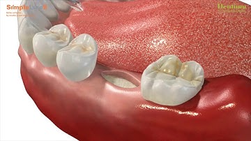 The return of tissue level implants