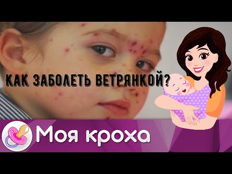 Как можно заболеть ветрянкой в домашних условиях