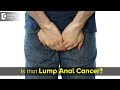 A lump down there – Is it cancer? Is it Piles ? Facts Revealed- Dr. Rajasekhar M R | Doctors&#39; Circle