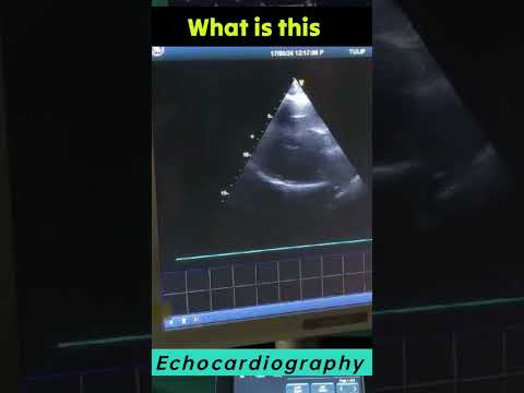 LVH In Echocardiography Blood Pressure K Baad Heart Kaisa Dikhta Hai Hypertension Concentric LVh