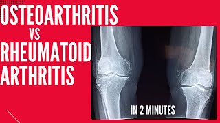 Osteoartritis vs Artritis Reumatoid dalam 2 menit!