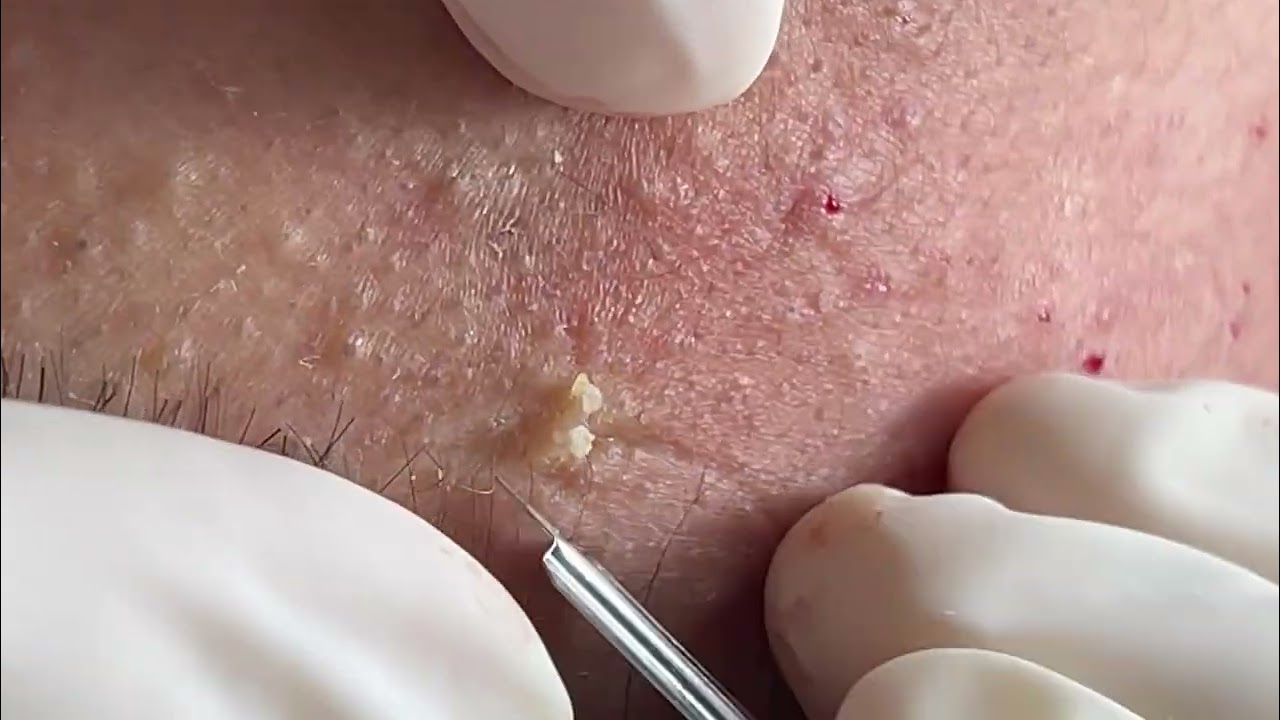 HOT HOT HOT ACNE BIG GIANT (His name is Tiến ) p1 - ĐIỀU TRỊ MỤN ĐÀ NẴNG MAI NGỌC