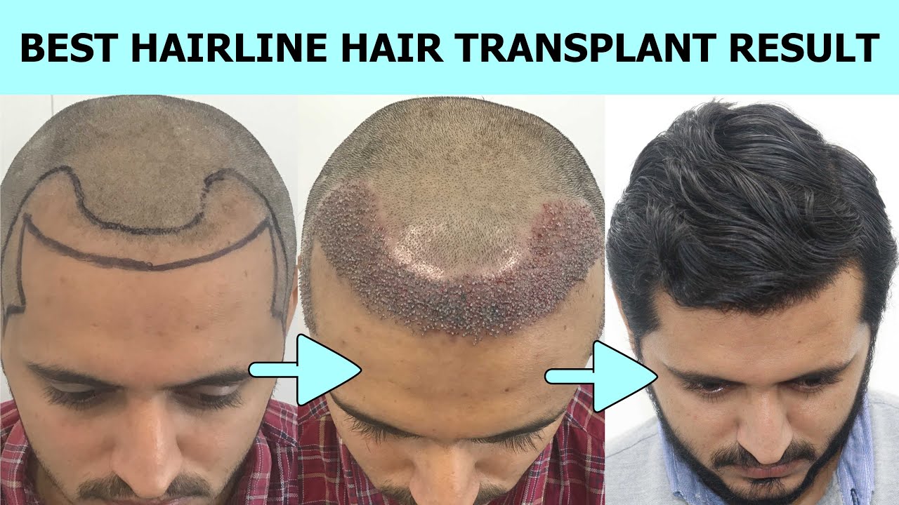 3 Best Hair Transplant Surgeons in Surat GJ  ThreeBestRated