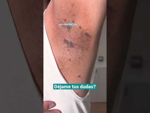 Vídeo: Com curar el liquen planus: 13 passos (amb imatges)