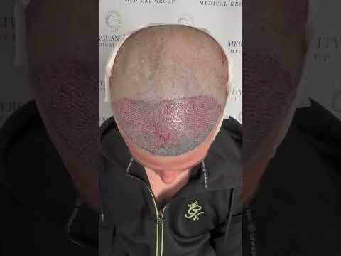 Hairline Reconstruction: 1900