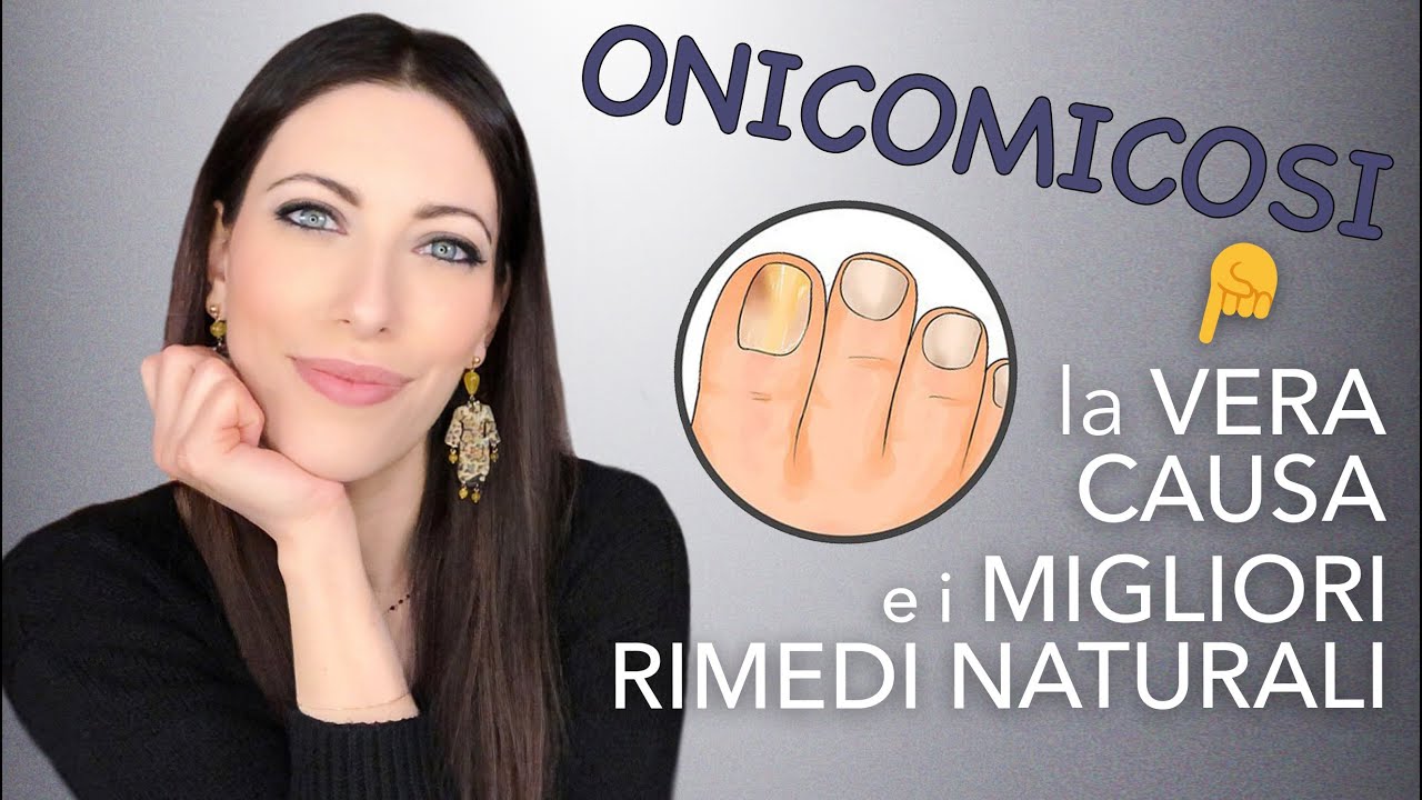 🦶🖐 Onicomicosi: qual è la vera causa e quali sono i possibili rimedi naturali
