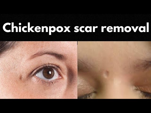 How to get rid of chickenpox scars : चिकेन पॉक्स के निशानों का समाधान || Dr. S.K. Gulati