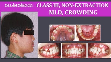 Ca 3 MEAW: hạng III, chen chúc, không nhổ răng, bn tăng trưởng, Class III, Non-extraction, crowding
