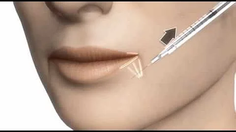 ¿Cómo se levantan las comisuras de los labios con Botox?