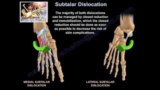 A lábak diszlokációjának tünetei és a sérülések kezelése - Álmatlanság Arthrosis subtalar ízület