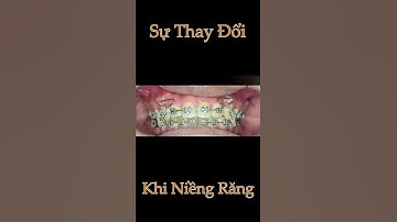 Sự thay đổi trước và sau khi niềng răng hô, khấp khểnh