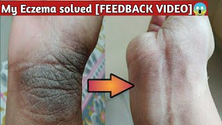 Eczema treatment at home. for eczema, psoriasis, fungal infection, itching, skin infection patient.