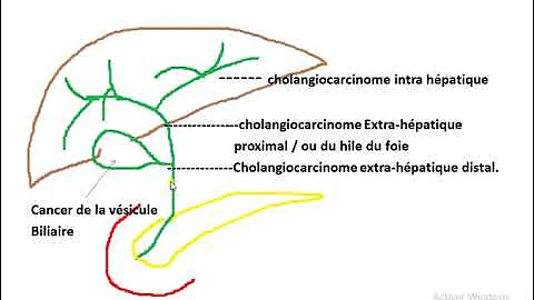 Comment detecter un cancer de la vesicule biliaire ?