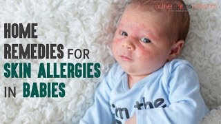 15 Home Remedies For Skin Allergies in Babies | ActiveMomsNetwork