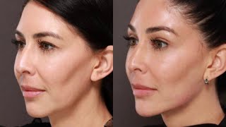 Jawline Filler Definition and Contouring