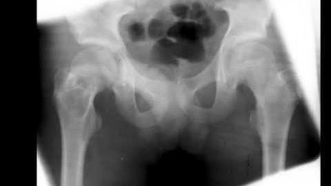 Simple Bone Cyst Right Femur