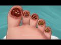 ASMR Maggot infested and fungal infection toenail removal | @SatisfyingASMRanimations