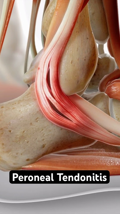 Swollen ankle = tendon damage? (3D Animation)