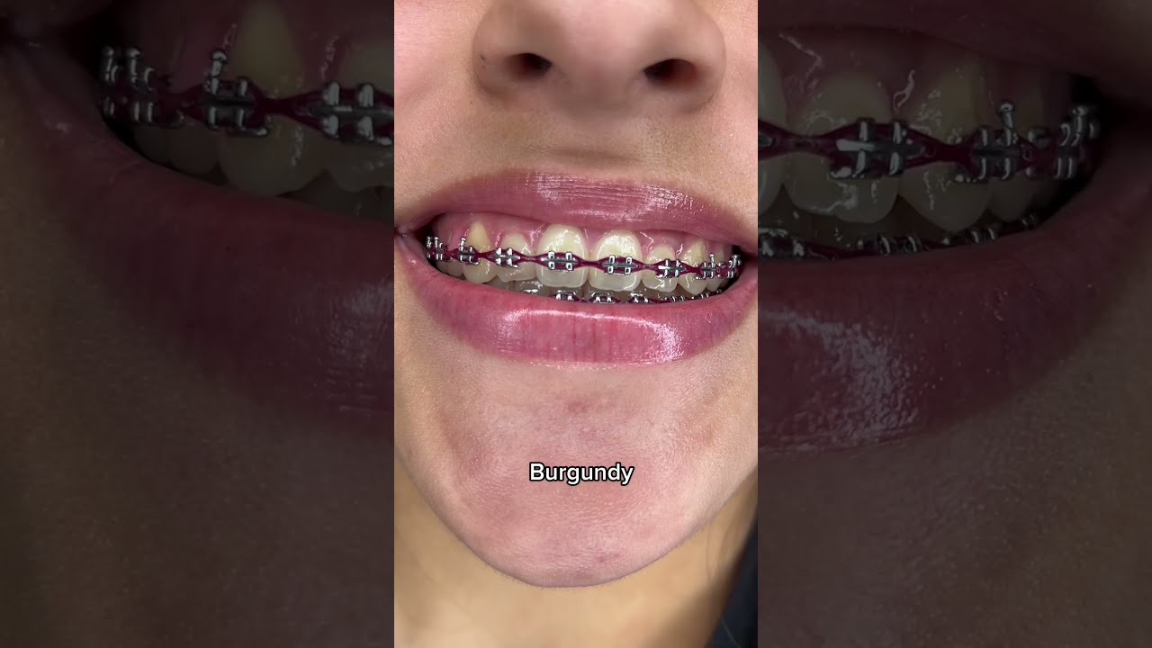 Best Braces Colors For Whiter Looking Teeth Part 1