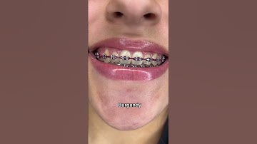 Thumbnail of Best Braces Colors for Whiter Looking Teeth Part 1