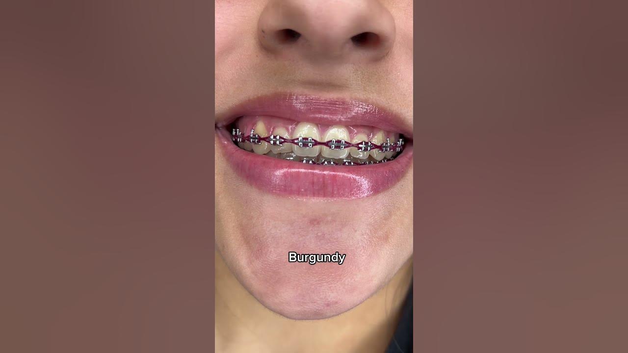 Best Braces Colors for Whiter Looking Teeth Part 1