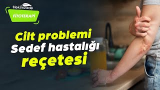 Sedef Hastalığı ve Cilt Problemlerinin Reçetesi
