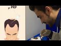 پی آر پی چیست مراحل انجامPRP پی آر پی چیست مراحل انجامPRP