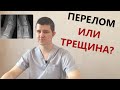 Перелом или трещина? | Доктор Драганик