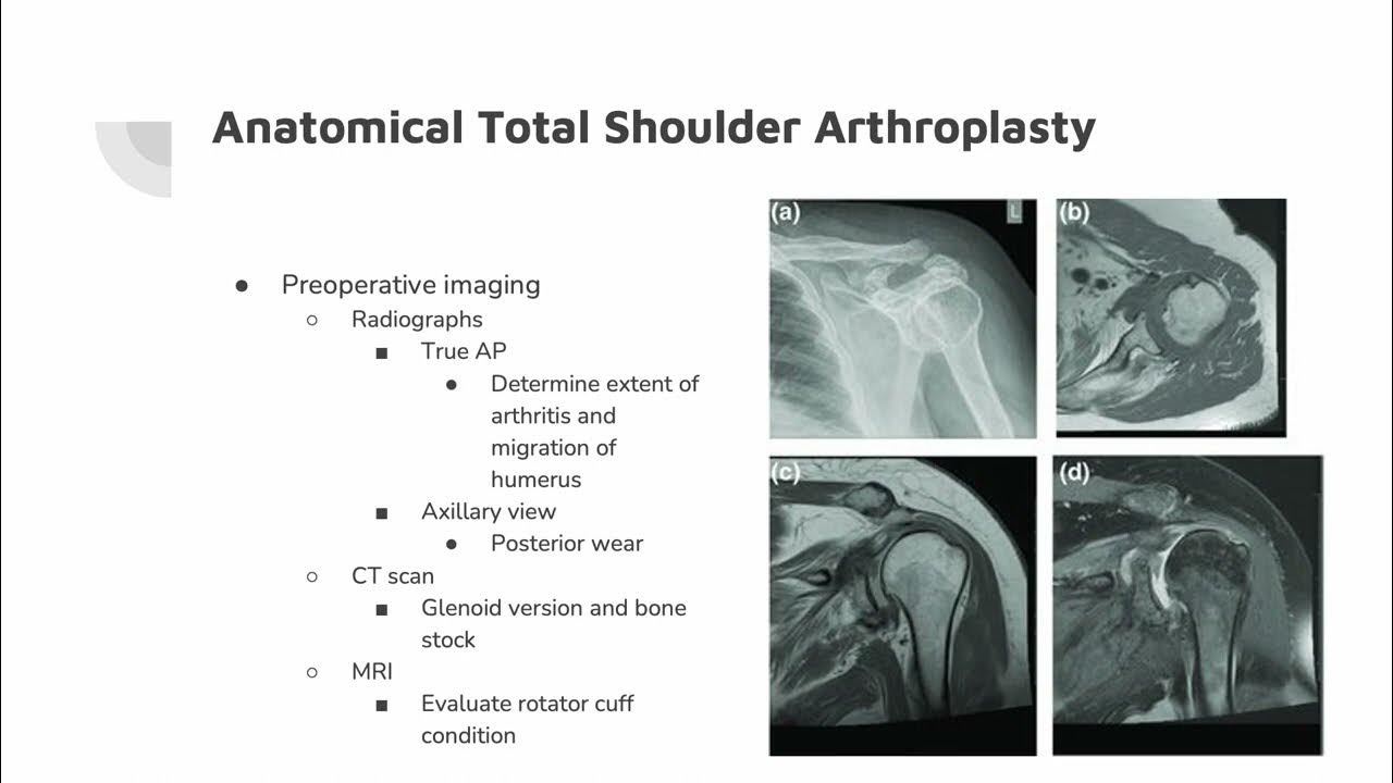 Total shoulder arthroplasty anatomical vs reverse tsom lunch club