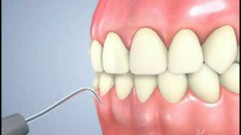 Dental Pick & Scaler