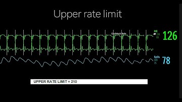 Pacemakers 201: Pacemaker Wenckebach