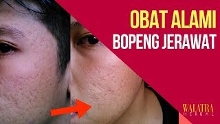 Real Testimoni QNC Jelly Gamat Membantu Menghilangkan Bopeng & Bekas Jerawat