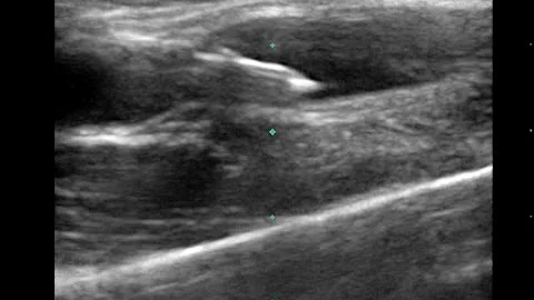 US Guided Long Axis (In-Plane) Peripheral IV Insertion