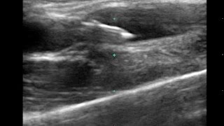US Guided Long Axis (In-Plane) Peripheral IV Insertion
