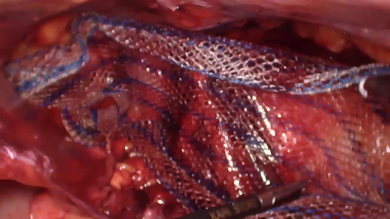 hernia inguinal laparoscopia recuperacion