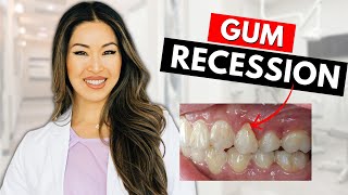 How to Treat and Reverse Gum Recession