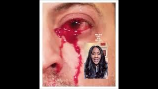 What Causes Bloody Tears? Why Do Some People Cry Tears of Blood? A Doctor Explains