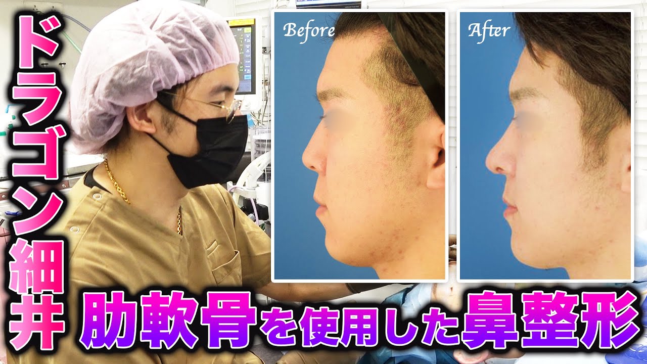 【メンズ】鼻整形&バッカルファット除去!Eラインを整える!【手術解説】