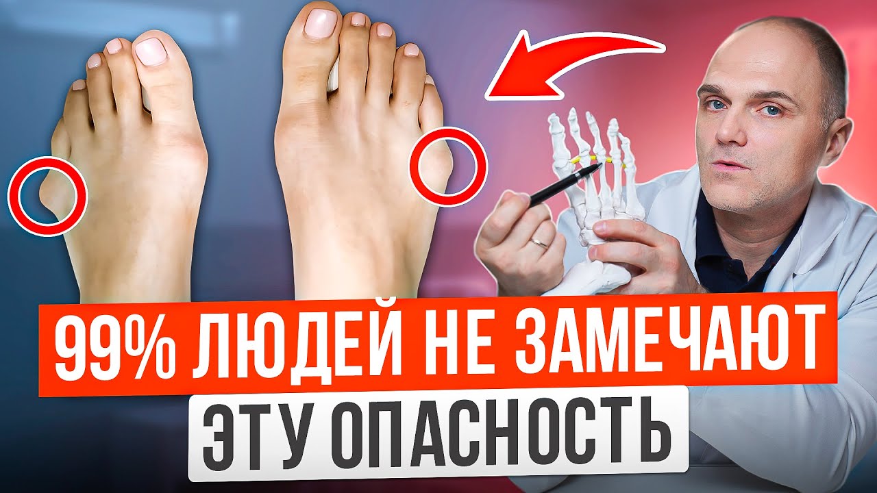 КАК ШИШКА НА МИЗИНЦЕ ведет к деформации ноги? Эти причины убийцы вашей стопы