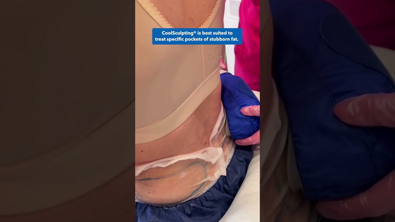 Coolsculpting in NYC