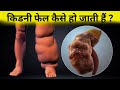 किडनी फेल कैसे होती हैं ? kidney failure in hindi