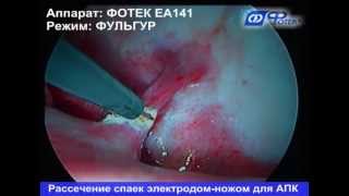 видео Спайки кишечника – последствие оперативного вмешательства